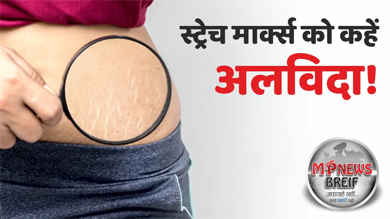 Stretch Marks Remove Tips