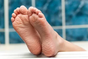 Why Does Skin Prune in Water? Causes and Prevention