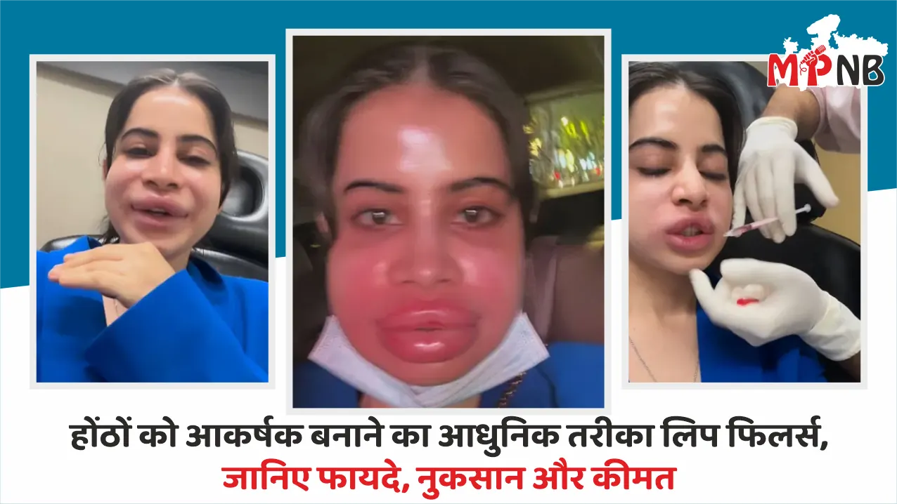 Modern lip enhancement with fillers